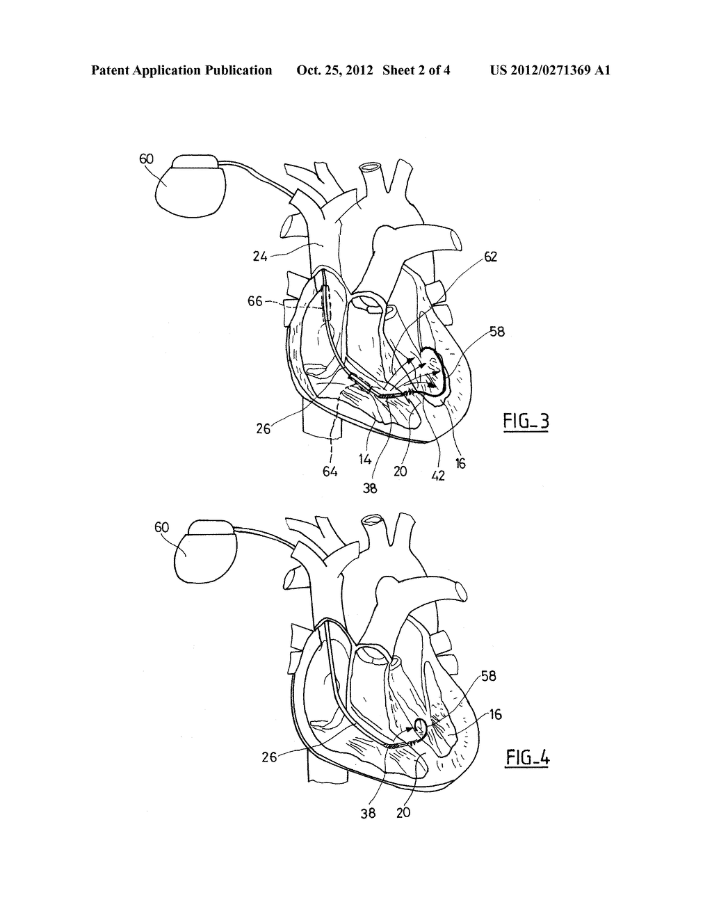 ENDOCARDIAL STIMULATION/DEFIBRILLATION SYSTEM OF THE LEFT VENTRICLE - diagram, schematic, and image 03