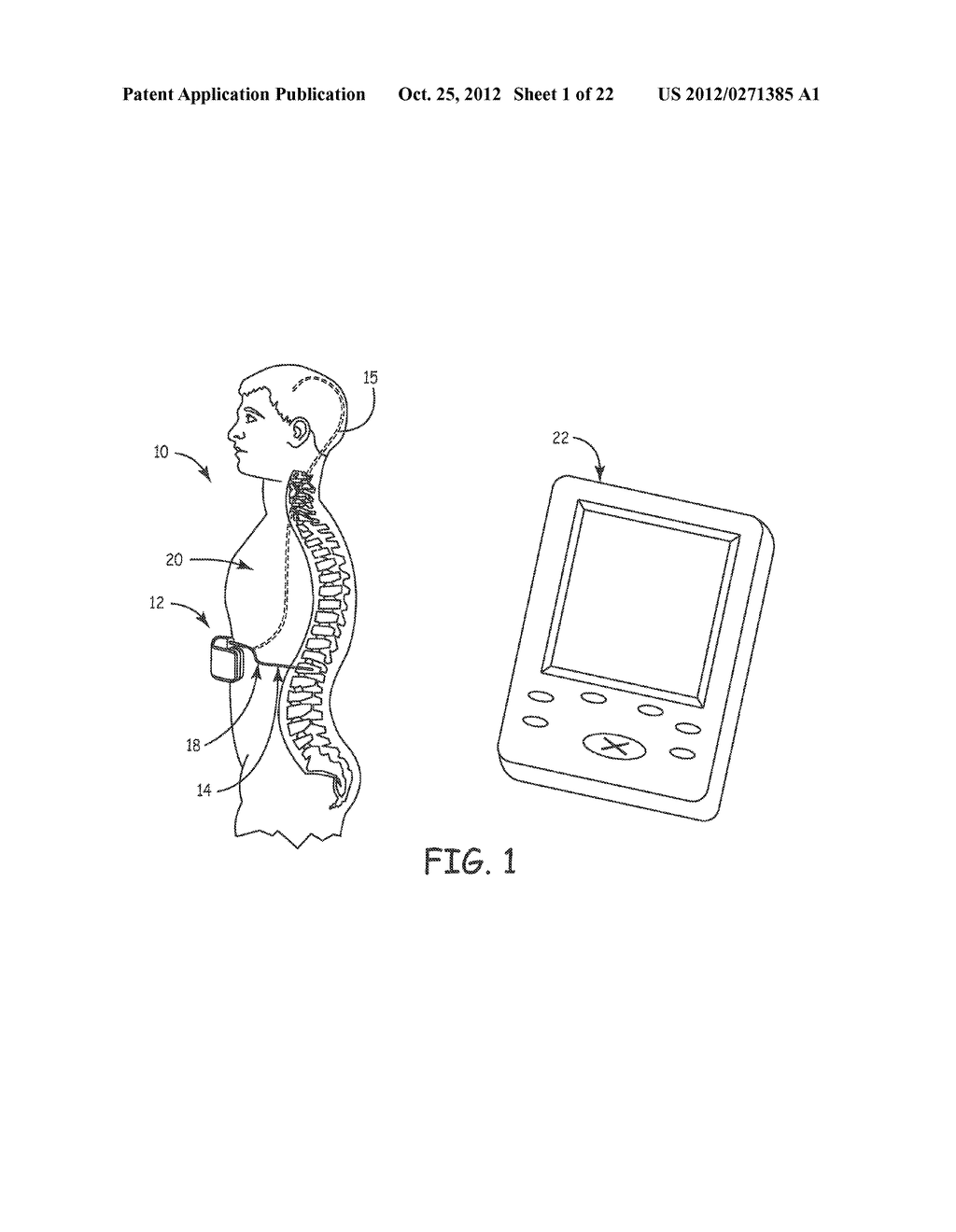 LOW IMPEDANCE, LOW MODULUS WIRE CONFIGURATIONS FOR A MEDICAL DEVICE - diagram, schematic, and image 02