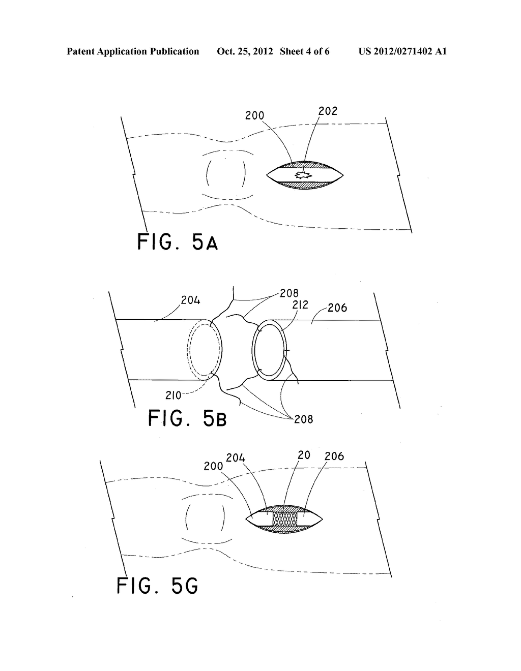 EMERGENCY VASCULAR REPAIR SYSTEM AND METHOD - diagram, schematic, and image 05