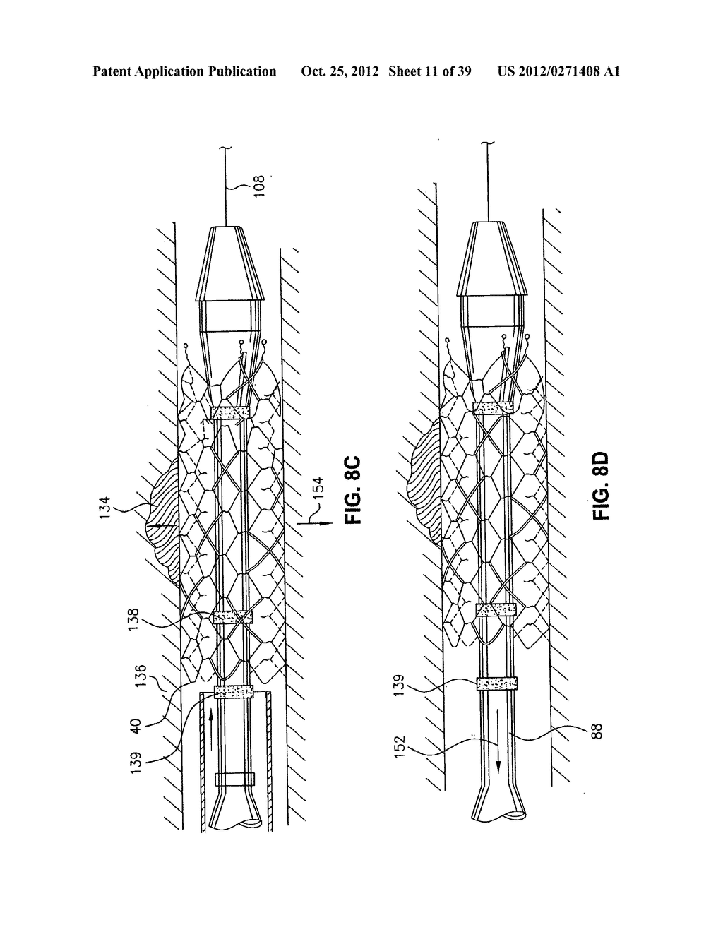 Low Profile Medical Stent - diagram, schematic, and image 12