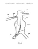 Helical Radiopaque Marker diagram and image