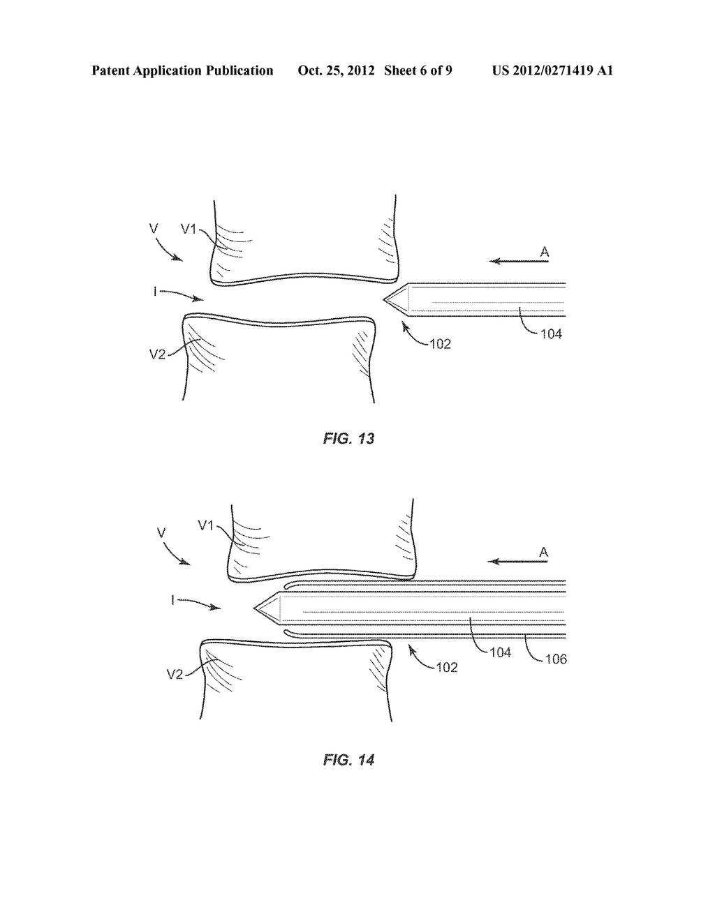 EXPANDABLE IMPLANT SYSTEM AND METHODS OF USE - diagram, schematic, and image 07