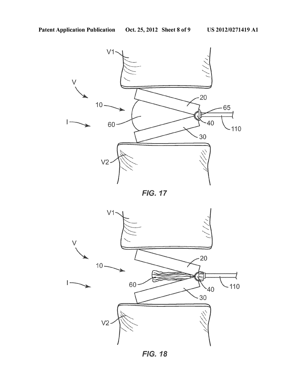 EXPANDABLE IMPLANT SYSTEM AND METHODS OF USE - diagram, schematic, and image 09