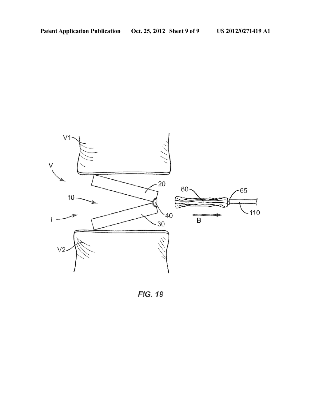 EXPANDABLE IMPLANT SYSTEM AND METHODS OF USE - diagram, schematic, and image 10