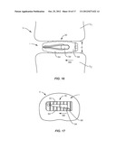 EXPANDABLE IMPLANT SYSTEM AND METHODS OF USE diagram and image