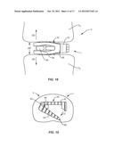 EXPANDABLE IMPLANT SYSTEM AND METHODS OF USE diagram and image