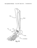 ANKLE ARTHROPLASTY diagram and image