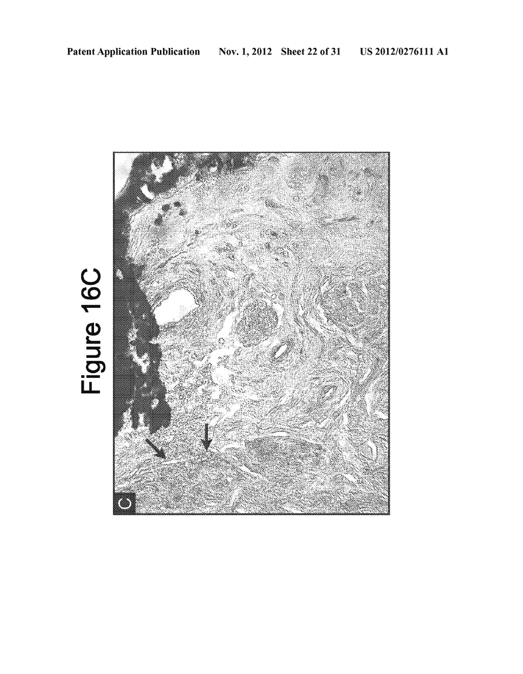 METHODS AND COMPOSITIONS FOR TREATING CONDITIONS ASSOCIATED WITH     ANGIOGENESIS USING A VASCULAR ADHESION PROTEIN-1 (VAP-1) INHIBITOR - diagram, schematic, and image 23