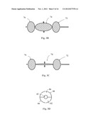 Balloon Resection Method diagram and image