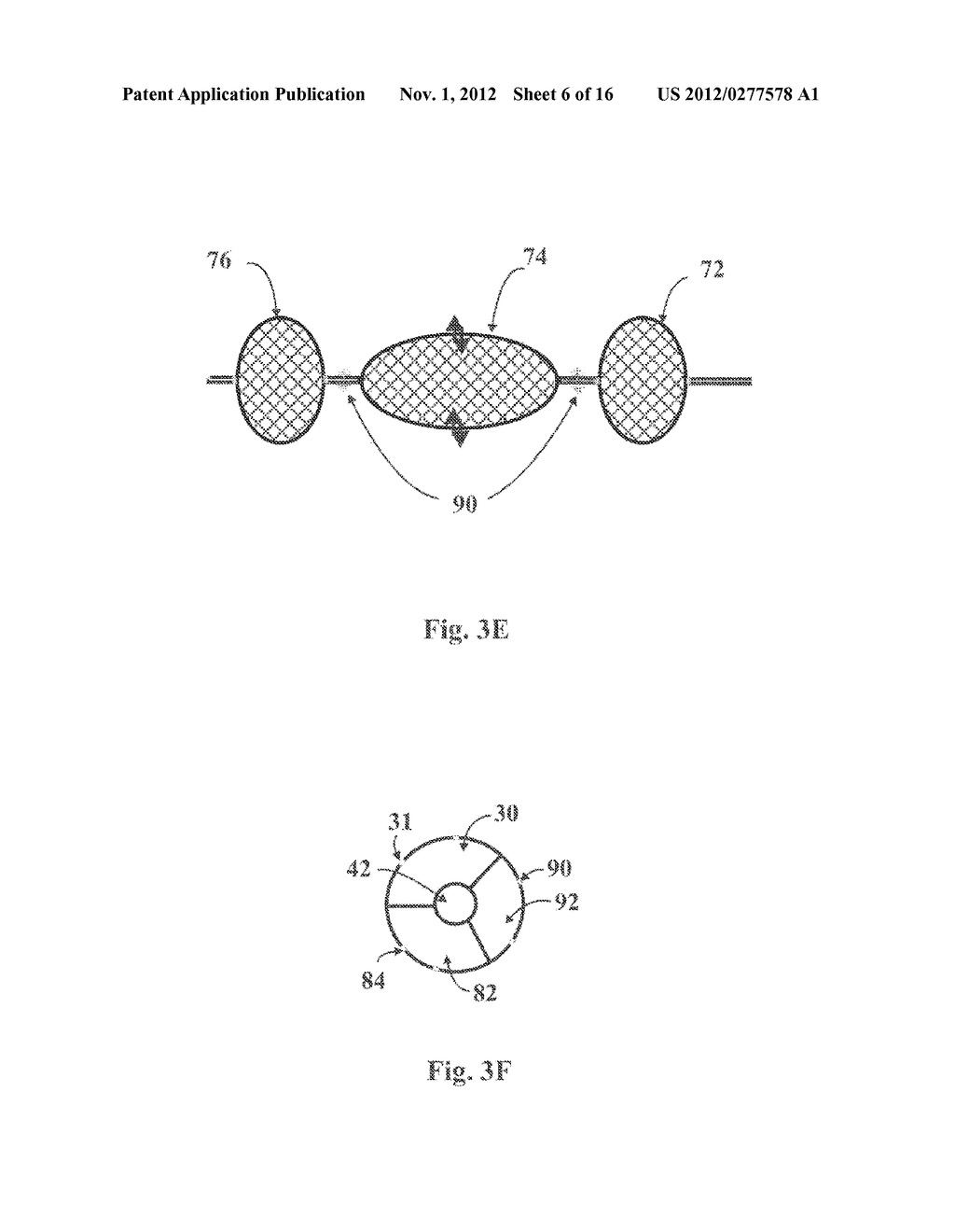 Balloon Resection Method - diagram, schematic, and image 07