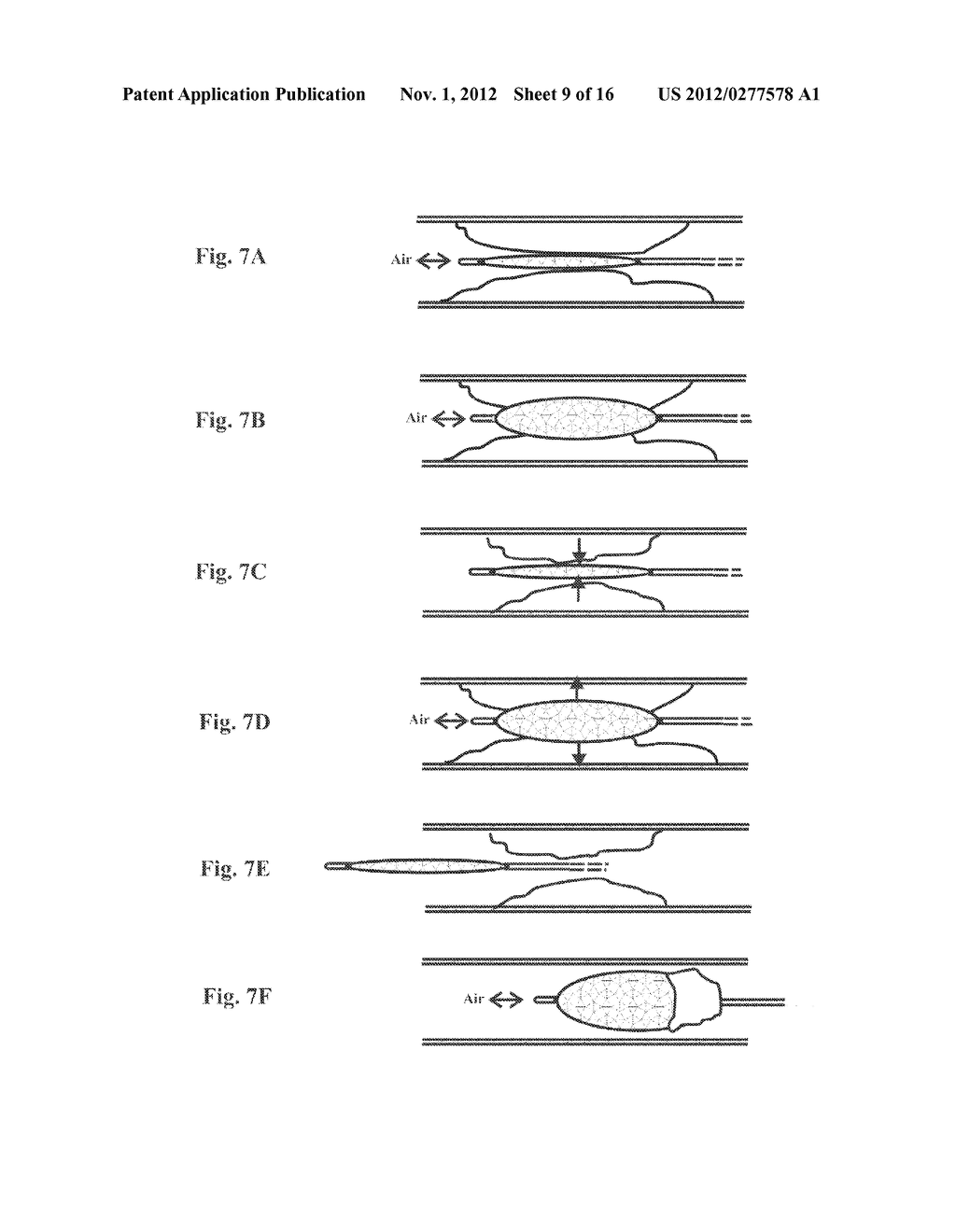 Balloon Resection Method - diagram, schematic, and image 10