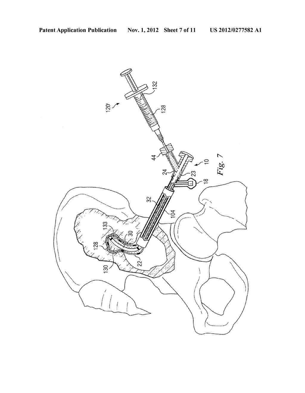 DEVICES AND METHODS FOR OSTEOLYTIC LESION ASSESSMENT USING A STEERABLE     CATHETER - diagram, schematic, and image 08