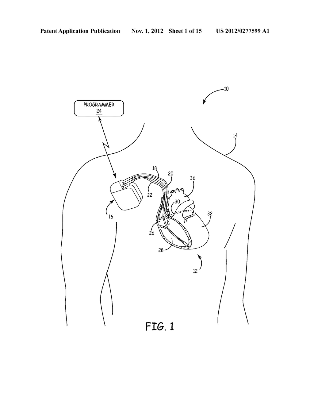 MEASUREMENT OF CARDIAC CYCLE LENGTH AND PRESSURE METRICS FROM PULMONARY     ARTERIAL PRESSURE - diagram, schematic, and image 02