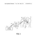 DISTINGUISHING PREMATURE CONTRACTIONS IN A MEDICAL DEVICE diagram and image