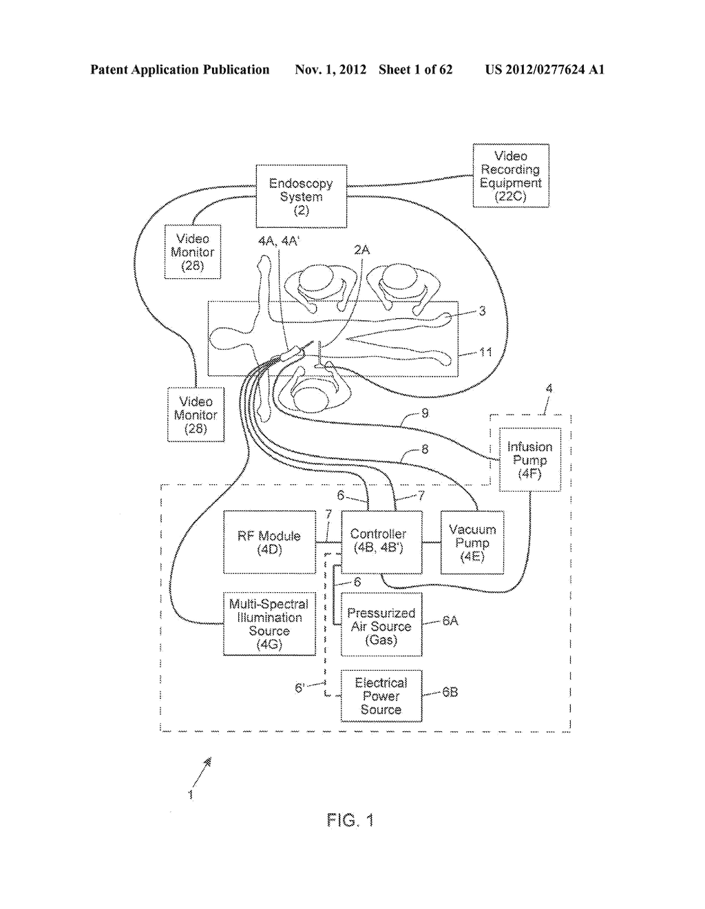 METHOD OF COLLECTING AND IN SITU PROCESSING OF ASPIRATED FAT TISSUE     SAMPLED FROM A HUMAN PATIENT DURING TISSUE ASPIRATION OPERATIONS - diagram, schematic, and image 02