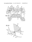 DISSECTION HANDPIECE AND METHOD FOR REDUCING THE APPEARANCE OF CELLULITE diagram and image