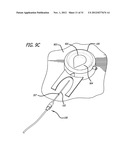 DISSECTION HANDPIECE AND METHOD FOR REDUCING THE APPEARANCE OF CELLULITE diagram and image