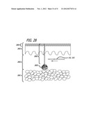 DISSECTION HANDPIECE AND METHOD FOR REDUCING THE APPEARANCE OF CELLULITE diagram and image