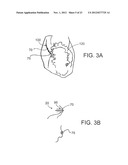 SYSTEMS AND METHODS FOR ENGAGING HEART TISSUE diagram and image