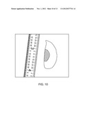 TISSUE ABLATION WITH IRREVERSIBLE ELECTROPORATION diagram and image