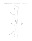 IMPLANT SYSTEM diagram and image