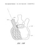 STEERABLE VERTEBROPLASTY SYSTEM WITH CAVITY CREATION ELEMENT diagram and image