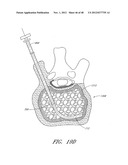 STEERABLE VERTEBROPLASTY SYSTEM WITH CAVITY CREATION ELEMENT diagram and image