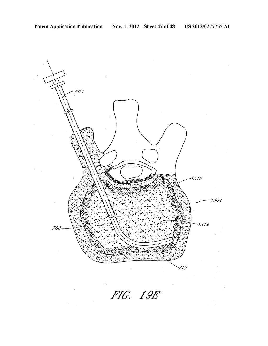 STEERABLE VERTEBROPLASTY SYSTEM WITH CAVITY CREATION ELEMENT - diagram, schematic, and image 48