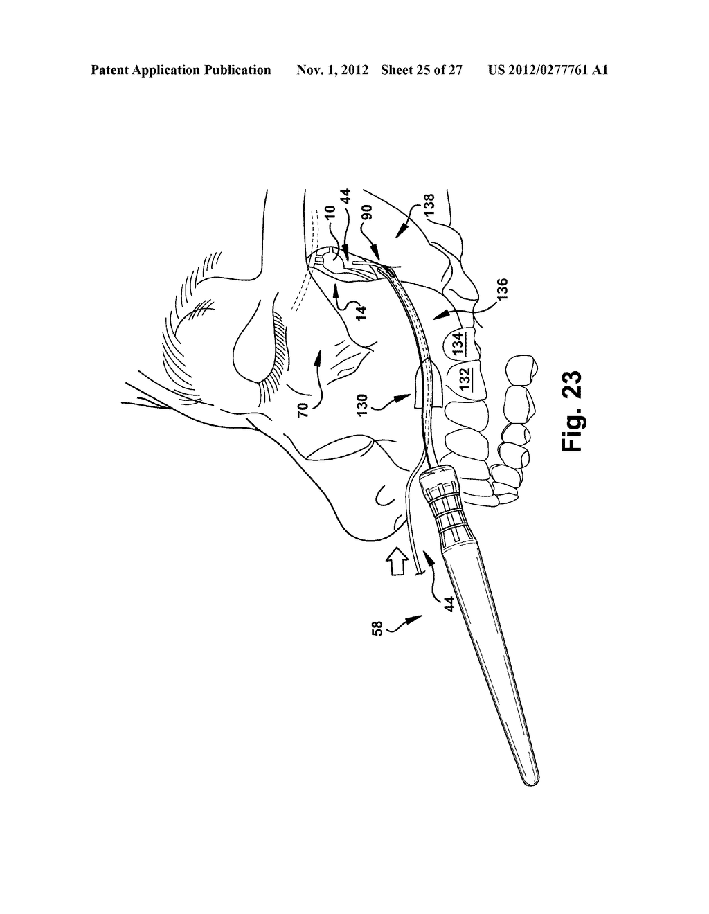 SURGICAL TOOLS TO FACILITATE DELIVERY OF A NEUROSTIMULATOR INTO THE     PTERYGOPALATINE FOSSA - diagram, schematic, and image 26