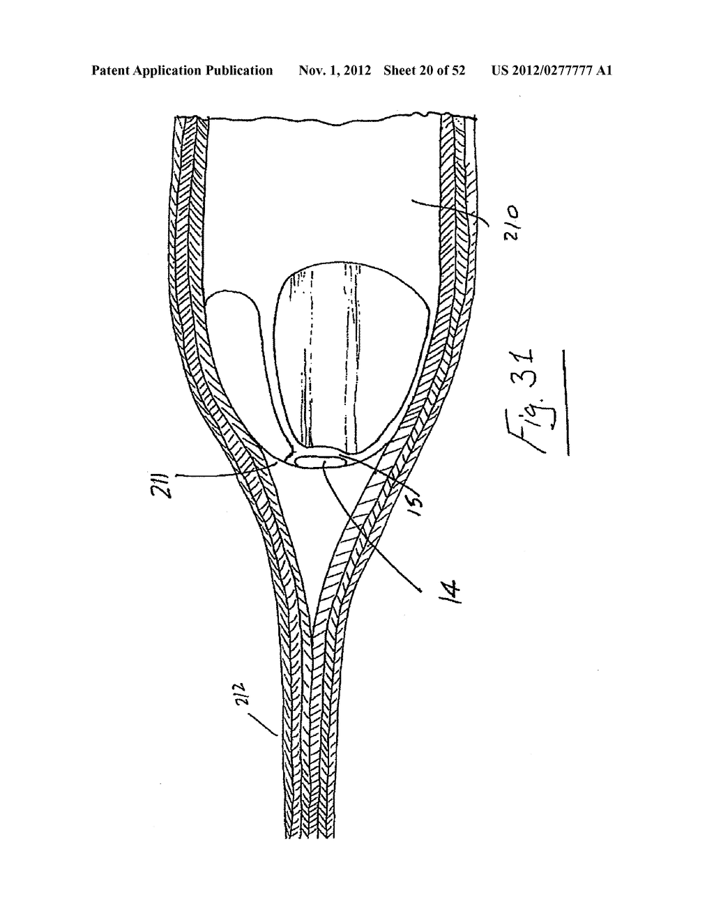 Vein stripping device - diagram, schematic, and image 21