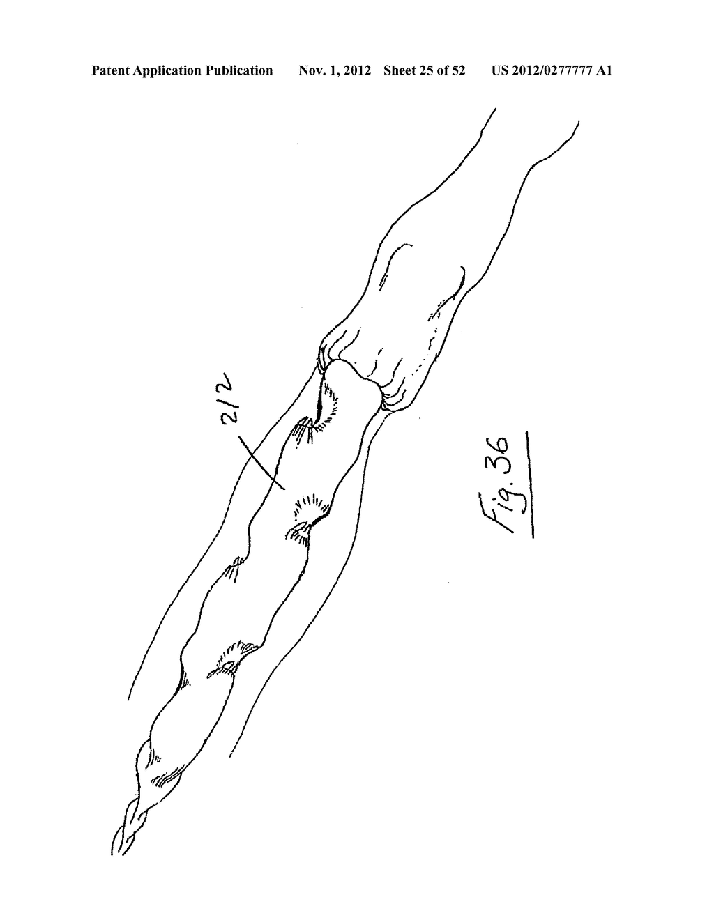 Vein stripping device - diagram, schematic, and image 26