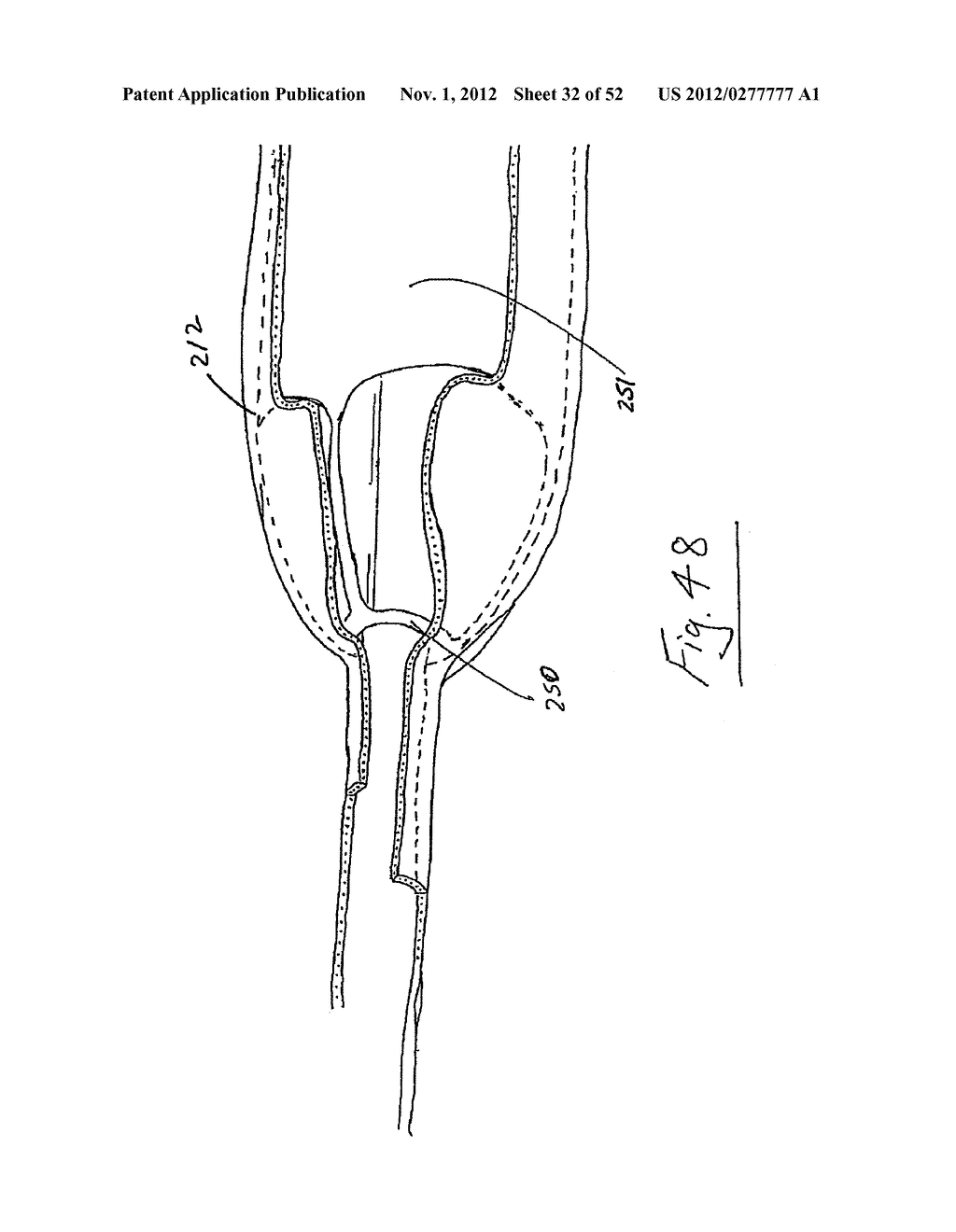 Vein stripping device - diagram, schematic, and image 33