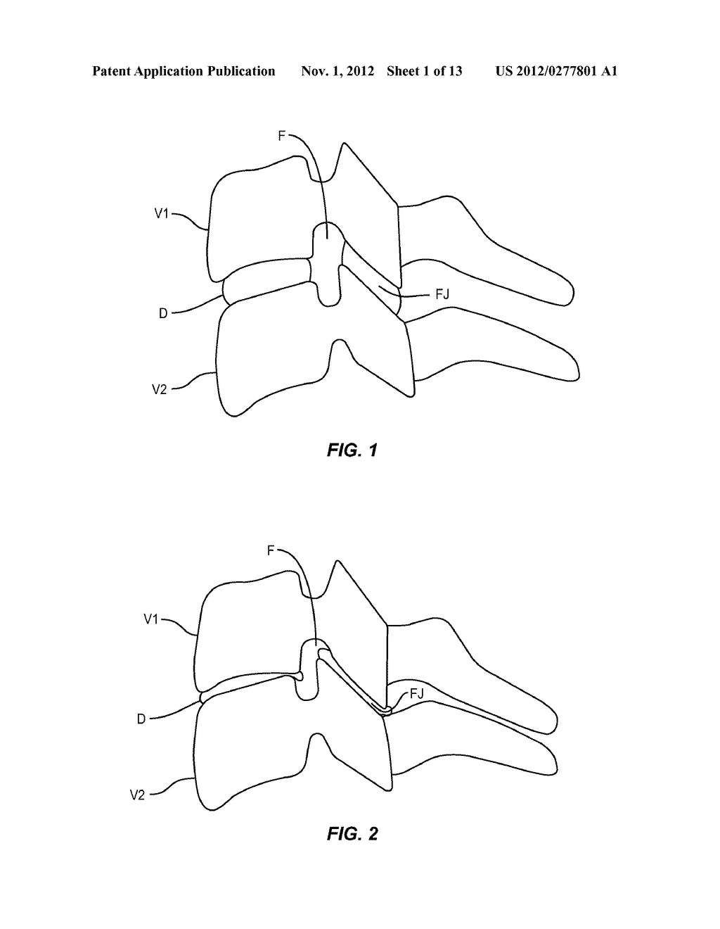 Methods and Instruments for Use in Vertebral Treatment - diagram, schematic, and image 02