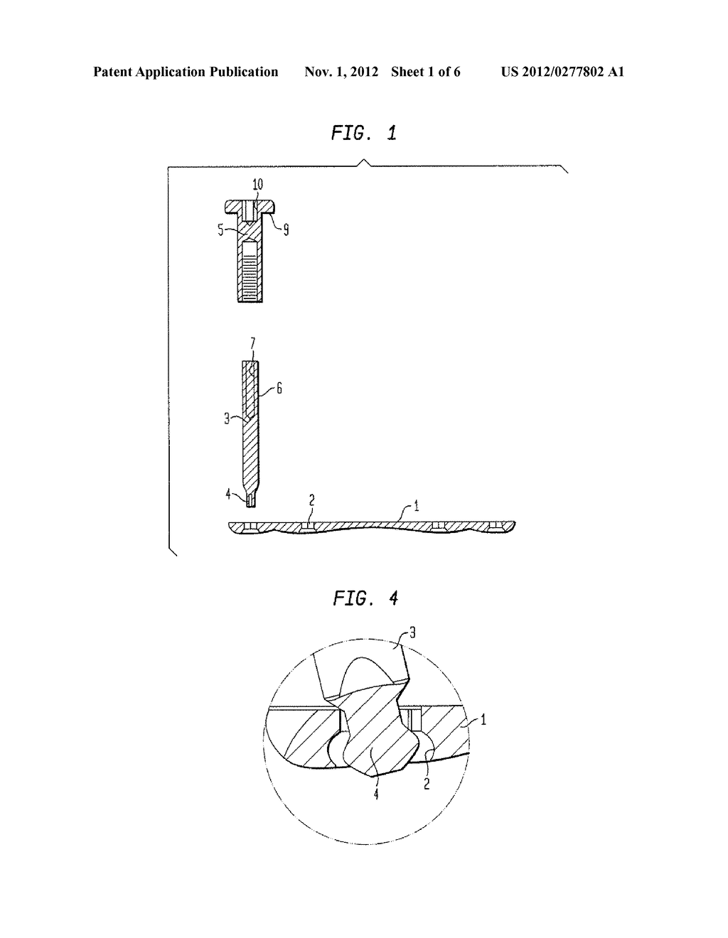 DEVICE FOR CREATING A BONE IMPLANT - diagram, schematic, and image 02