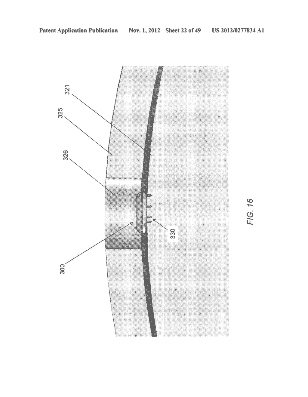 MICROFABRICATED SURFACE NEUROSTIMULATION DEVICE AND METHODS OF MAKING AND     USING THE SAME - diagram, schematic, and image 23