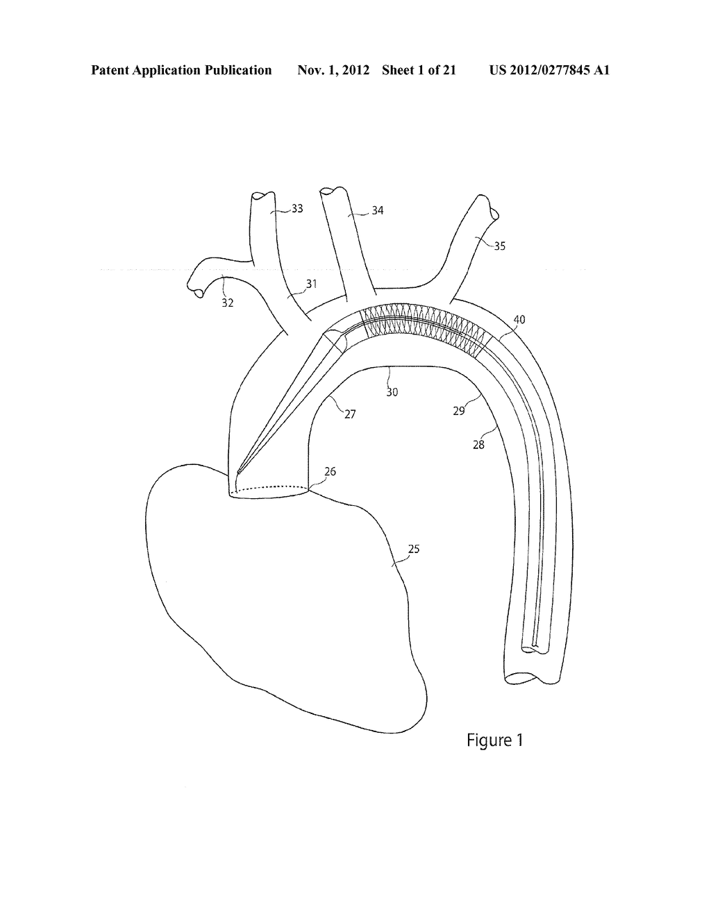 DELIVERY SYSTEM WITH RETRACTABLE PROXIMAL END - diagram, schematic, and image 02