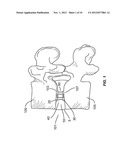 EXPANDABLE SPINAL INTERBODY IMPLANT diagram and image