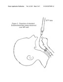 Negative Pressure Intubation Device diagram and image