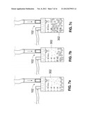 AUTOLOGOUS SURGICAL BONE COLLECTION AND FILTRATION diagram and image