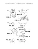 AUTOLOGOUS SURGICAL BONE COLLECTION AND FILTRATION diagram and image