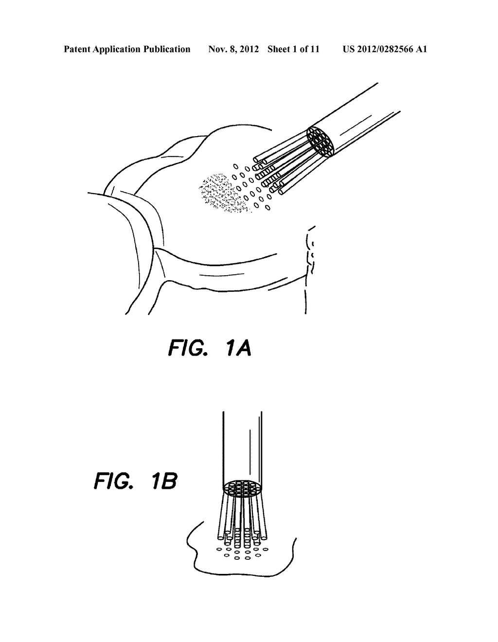 PROBES AND BIOFLUIDS FOR TREATING AND REMOVING DEPOSITS FROM TISSUE     SURFACES - diagram, schematic, and image 02