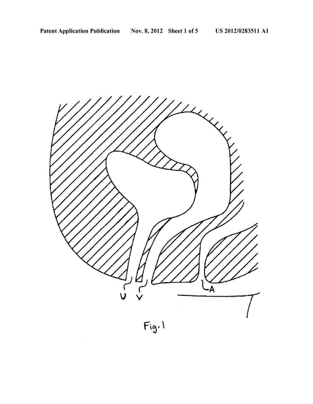 Elongate Implant System and Method for Treating Pelvic Conditions - diagram, schematic, and image 02