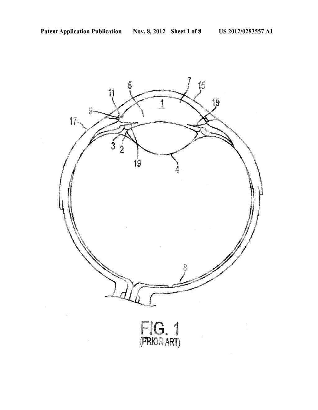 Methods and Apparatuses for the Treatment of Glaucoma using visible and     infrared ultrashort laser pulses - diagram, schematic, and image 02