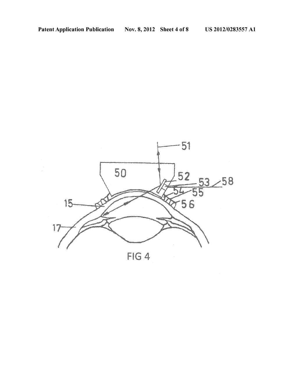 Methods and Apparatuses for the Treatment of Glaucoma using visible and     infrared ultrashort laser pulses - diagram, schematic, and image 05