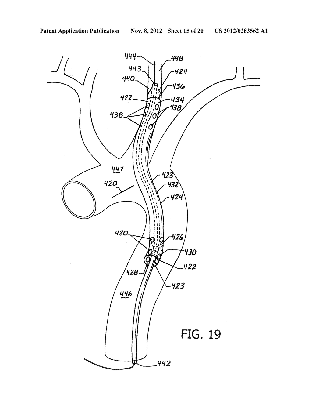 In Situ Modification of Therapeutic Agents Using Heat Exchange Catheter     System - diagram, schematic, and image 16