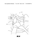 HIP SURGERY SYSTEMS AND METHODS diagram and image