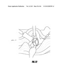 HIP SURGERY SYSTEMS AND METHODS diagram and image