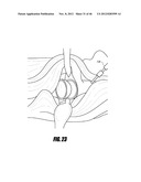 HIP SURGERY SYSTEMS AND METHODS diagram and image