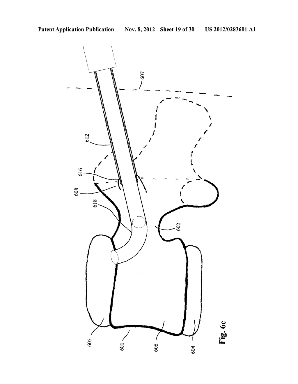 Method and Device for Restoring Spinal Disk Functions - diagram, schematic, and image 20