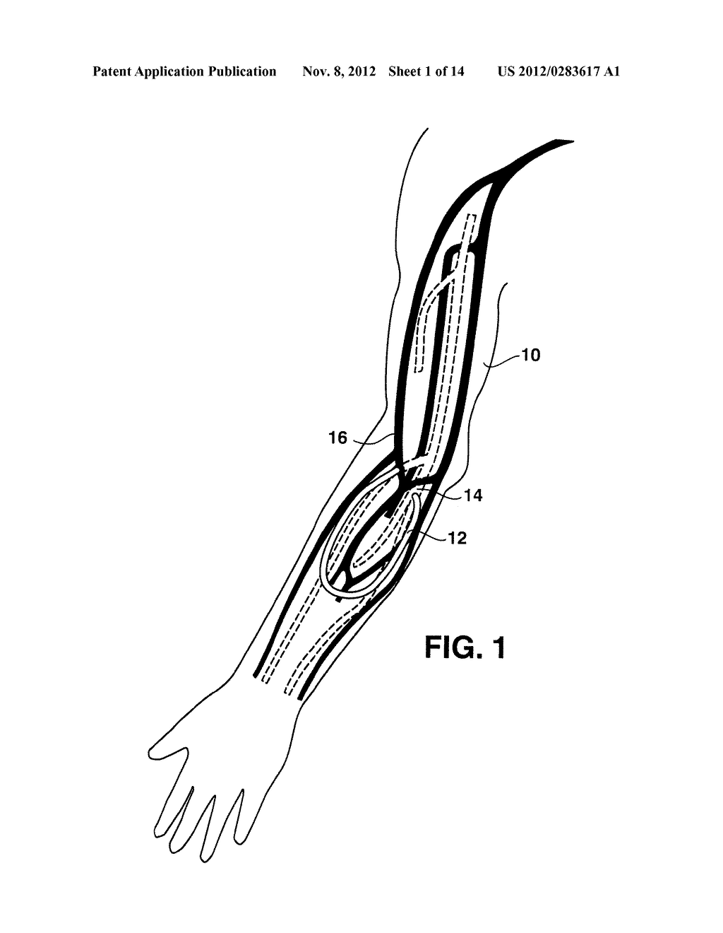 Arteriovenous Access Valve System and Process - diagram, schematic, and image 02